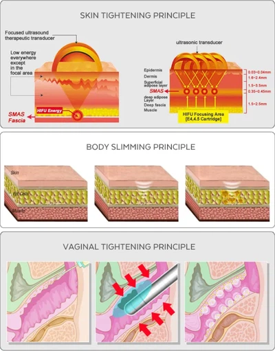 vigina tightening wand1 vigina tightening wand1