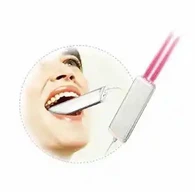 দাঁত গহ্বর জন্য লেজার চিকিত্সা